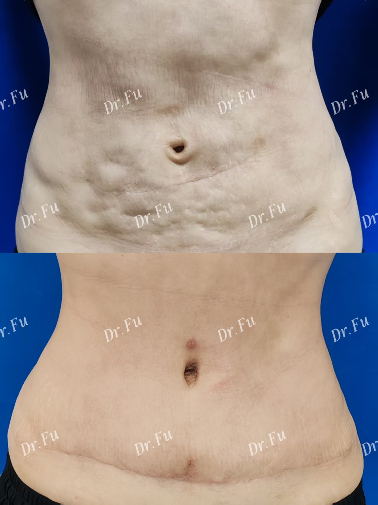 Abdominoplasty Case 3